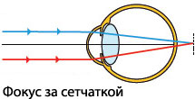 Фокусирование лучей в близоруком глазу